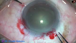 Two routine Phacosurgeries - soft cataract, grade II NS : Pradip Mohanta, 18 August, 2020 screenshot 5