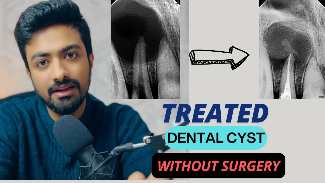 NON- SURGICAL TREATMENT OF PERIAPICAL CYST #dentistry