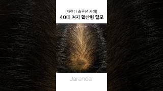 [자란다 솔루션 사례] 40대 여자 확산형 탈모 #여성탈모