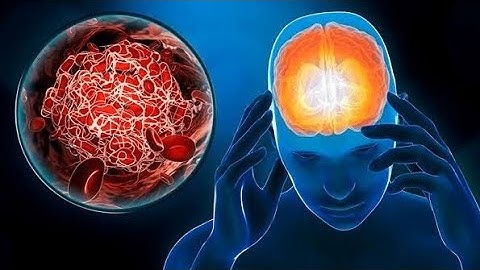 Cerebral Venous Sinus Thrombosis (CVST) VEIN STRIKE !