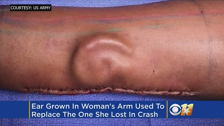Texas Surgeons Grow New Ear On Soldier's Arm For Transplantation