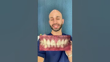 Gap between your front teeth? Watch this video!