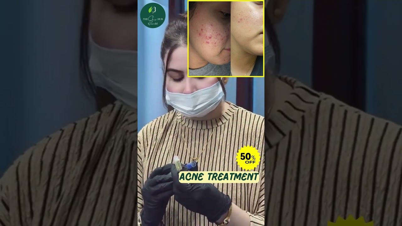 Anti-Acne Treatment—50% OFF Book your session today 