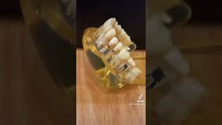 ما هو علاج كسر ابرة العصب داخل سني؟ #طبيب #dentist #طبيب_أسنان #الأسنان #dental #teeth #lifehacks