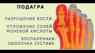 ЭТО СКРЫВАЮТ - ПУРИНЫ ВЫЗЫВАЮТ ПОДАГРУ И ЧТО ДЕЛАТЬ 9.09.2017 ЭТО СКРЫВАЮТ - ПУРИНЫ ВЫЗЫВАЮТ ПОДАГРУ И ЧТО ДЕЛАТЬ 9.09.2017
