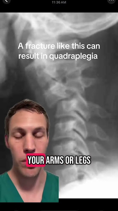 Case report: High neck injury results in paralysis