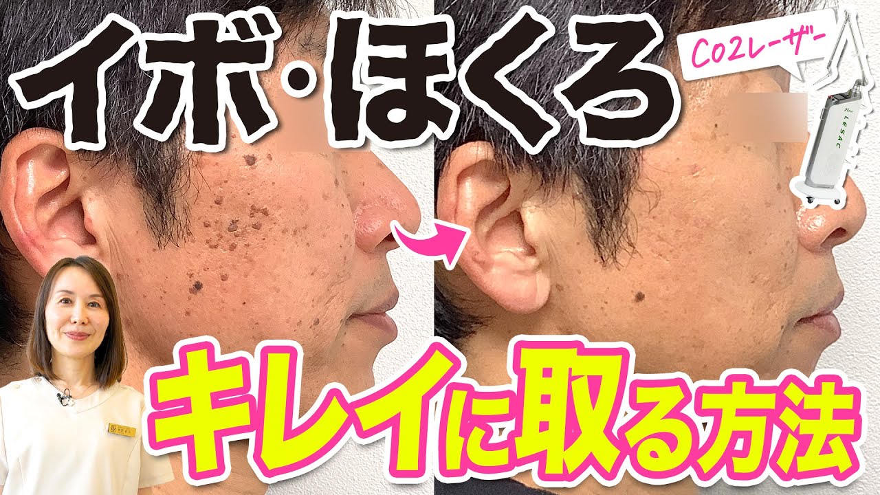 【イボ・ほくろ】炭酸ガスレーザーですっきり除去！