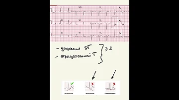 Стенокардия. Ишемия миокарда. ЭКГ диагностика.#Shorts