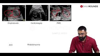 Fetal Imaging Sample Video Fetal Macrosomia & Large For Gestational Age By Dr. Basil Mathews
