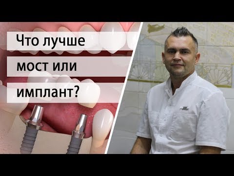 Что лучше имплант или мост?