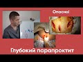 Глубокий ПАРАПРОКТИТ  Опасно!