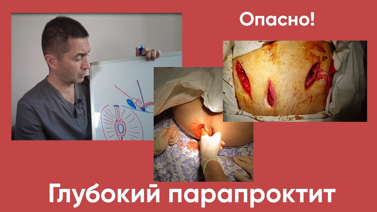 Глубокий ПАРАПРОКТИТ Опасно!