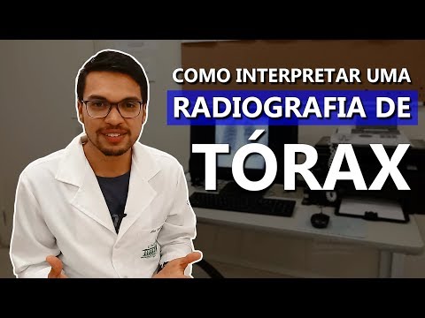 Vídeo: Precisão Das Medidas De Anteversão Planar Usando Radiografias Em Anteroposterior