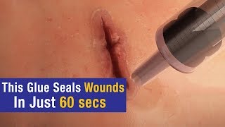 This glue seals wounds in just 60 secs