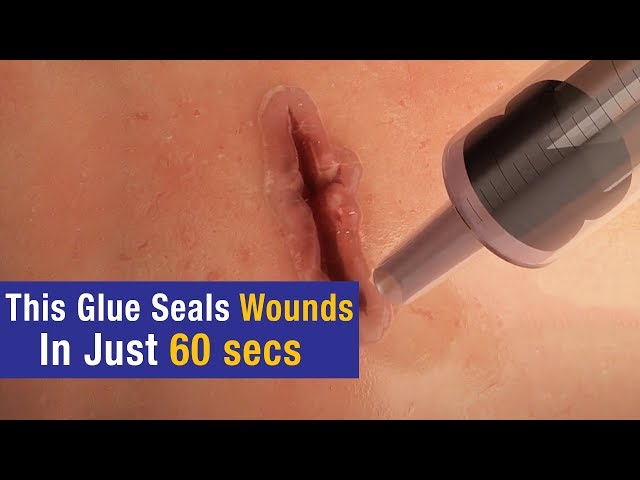 This surgical glue seals wounds without staples or stitches., This surgical  glue seals wounds without staples or stitches., By GIGadgets