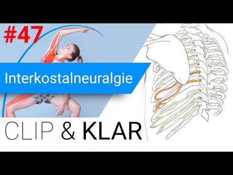 Interkostalneuralgie erklärt - Zwischen-Rippen-Nervenschmerz