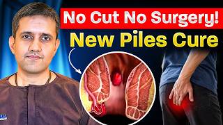 Piles का Permanent Treatment? | Hemorrhoid Artery Embolization (HAE) | No Pain, No Surgery