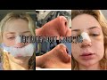 REALITY OF GETTING A NOSE JOB (vlog, price, before & after, etc.)