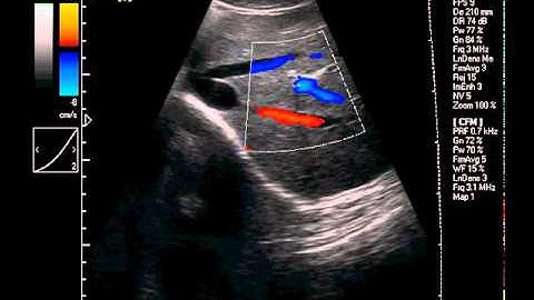 Color Doppler Ultrasound system MSLCU31 convex array probe video