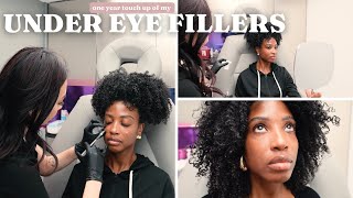 One Year Under Eye Filler Update | Aisha Beau