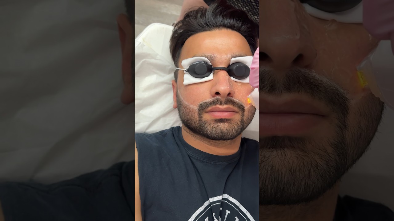 Get rid of PIMPLES❤️edmonton 