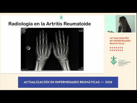 Vídeo: ¿Es La Artritis Reumatoide? Las Diferencias Entre RA Y OA
