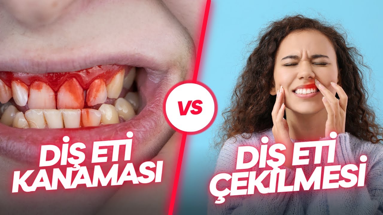 Diş Eti Kanaması Neden Olur.? Diş Eti Çekilmesi Tedavisi.