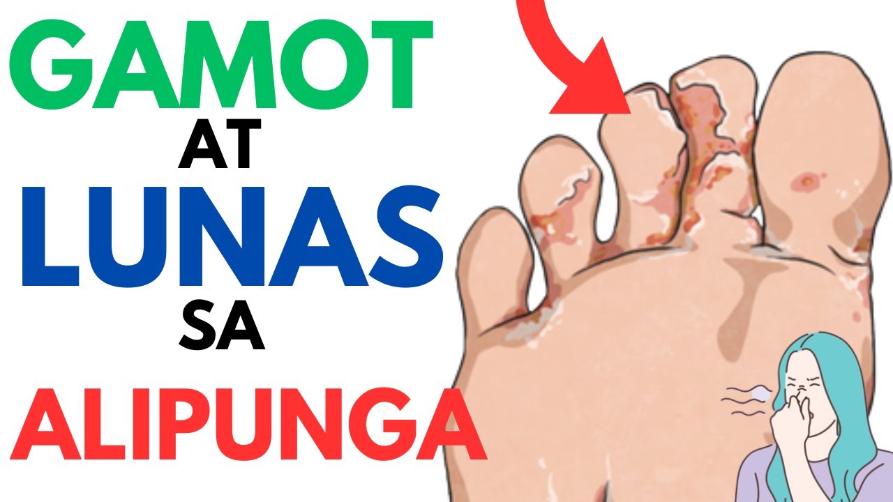 🦶 Gamot at Lunas sa ALIPUNGA | Paano mawala at matanggal ang ATHLETE'S ...