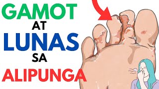 ? Gamot at Lunas sa ALIPUNGA | Paano mawala at matanggal ang ATHLETES FOOT + Home Remedies