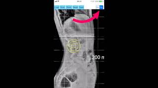 How to measure Spinopelvic balance with the App by Orthopractis.com screenshot 2