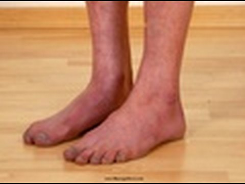 Redness between legs | Healthypages Forums
