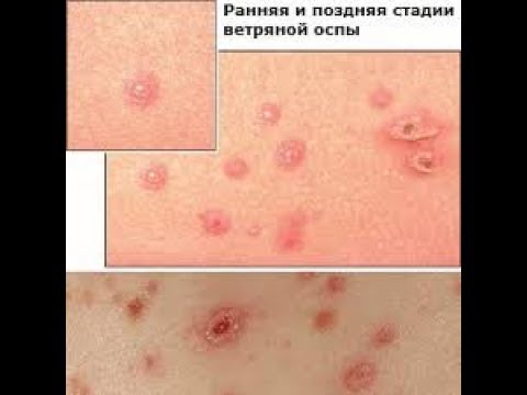 Chickenpox how to quickly cure chickenpox