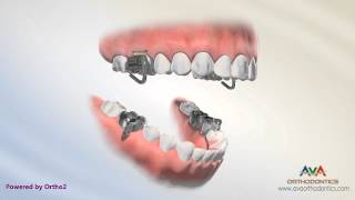 Orthodontic Treatment for Overjet (Overbite) - MARA Appliance