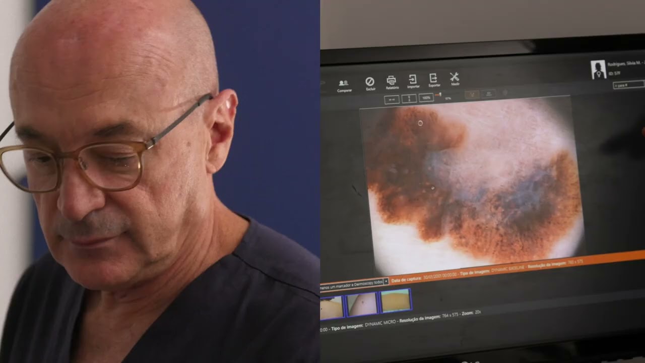 Câncer de Pele: Sintomas e Como Prevenir -  Saúde da Pele Com Dr. Tovo