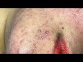 Blackheads on the girls peeling skin phuong p5 hoangmyspa93