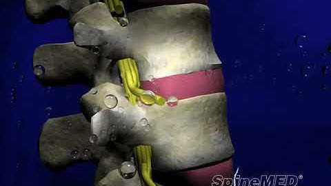 SpineMED® Patient Education