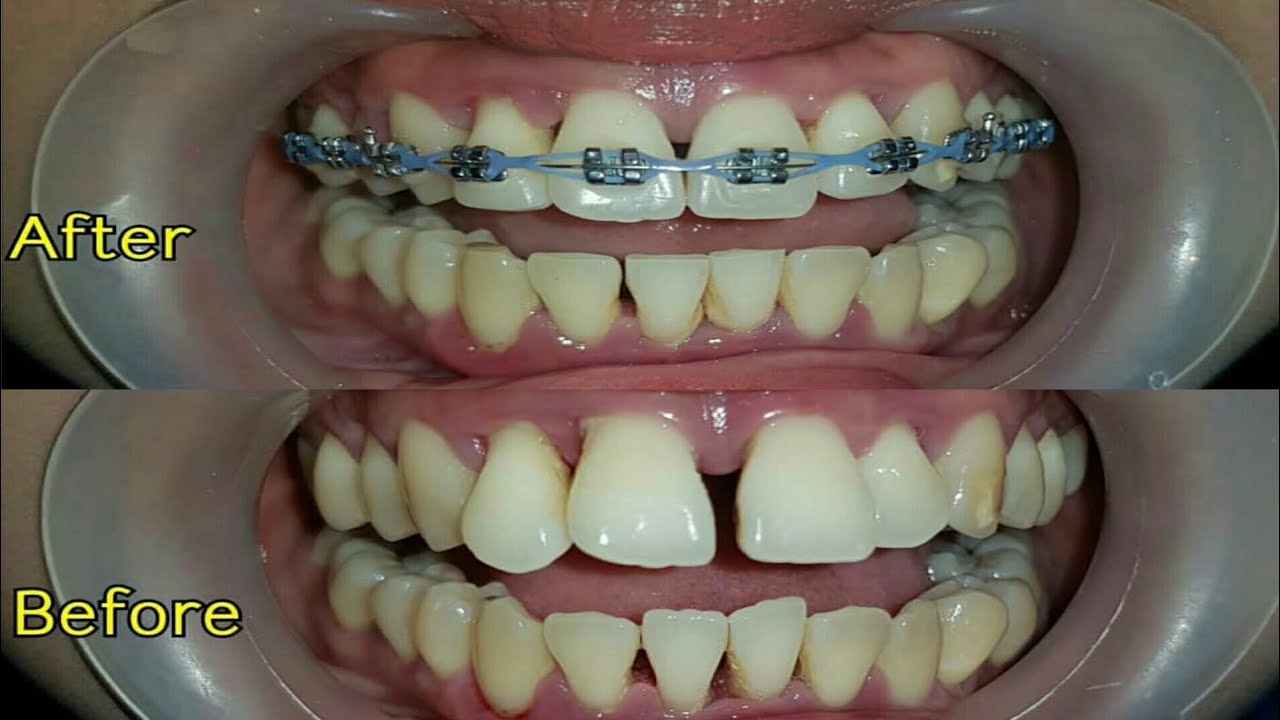 Braces Time Lapse! 6 week YouTube