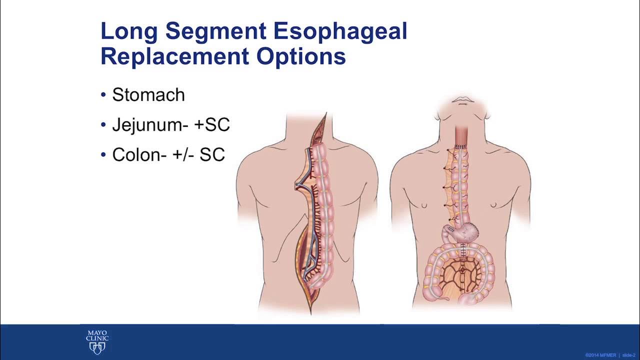 Long Segment SuperCharged Jejunal Interposition YouTube