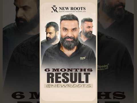 3000 Grafts Hair Transplant in Pune | Hair Transplant Cost & Results #hairtransplant #shorts