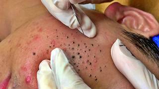 Blackhead Removal With Today Spa #2649