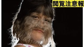 【衝撃】世界でも稀な全身が毛だらけの狼男症候群の子供たち… 狼男症候群 検索動画9 【衝撃】世界でも稀な全身が毛だらけの狼男症候群の子供たち… 狼男症候群 検索動画 9