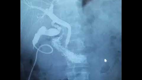 intraoperative cholangiogram