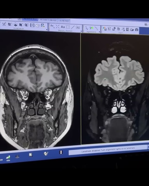 High resolution and High SNR 3D MRI using AIR Recon DL & HyperSense3D BRAVO: 2:27s3D Cube FLAIR