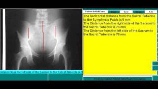 Pelvic X-ray Analysis