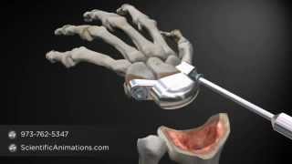 Wrist Replacement Procedure