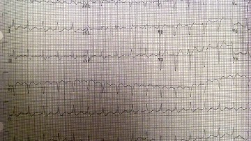 Atrial Flutter 2:1