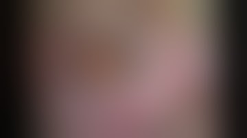 Phacoemulsification and iris fixation in case of severe phacodonesis