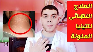 إزاى نعالج التينيا الملونة؟!Tinea versicolour