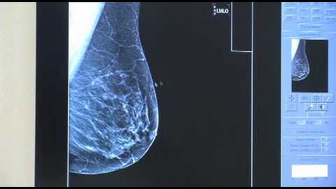 MAMMOGRAPHY