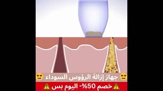 جهاز إزالة الرؤوس السوداء